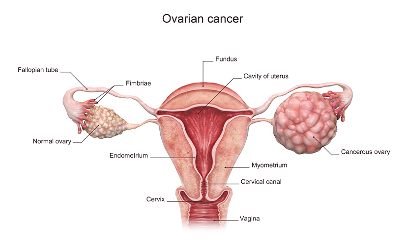 ওভারিয়ান বা ডিম্বাশয়ের ক্যান্সার সম্পর্কে জানুন এবং সচেতন হোন