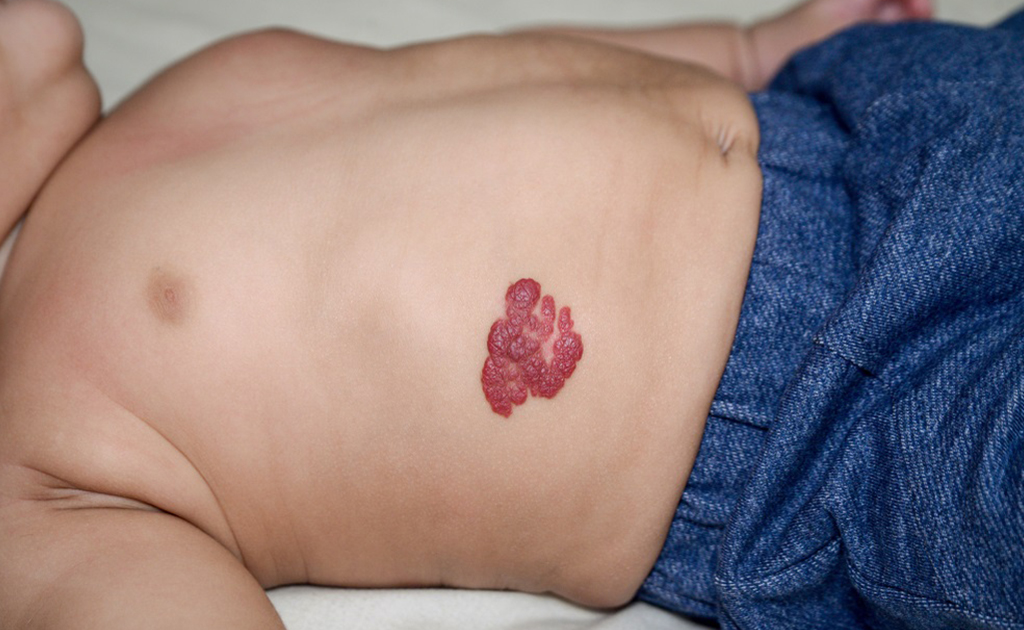 জন্মদাগ ও তিল কি জটিল কোনো বিষয়? কেন হয় ও চিকিৎসা