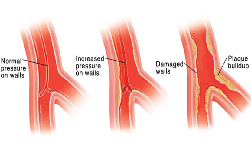 হাই ব্লাড প্রেশার | হাইপারটেনশন বা উচ্চ রক্তচাপ প্রতিরোধে ১০টি সহজ সমাধান