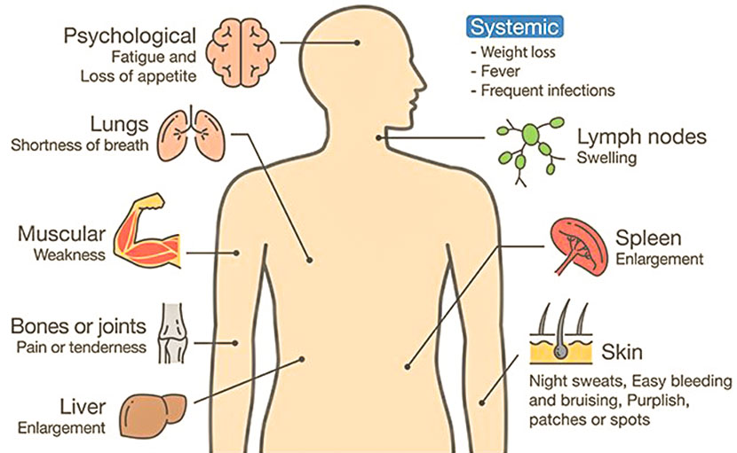 ব্লাড ক্যান্সার (লিউকোমিয়া) | লক্ষণ জানুন, সতর্ক হোন!