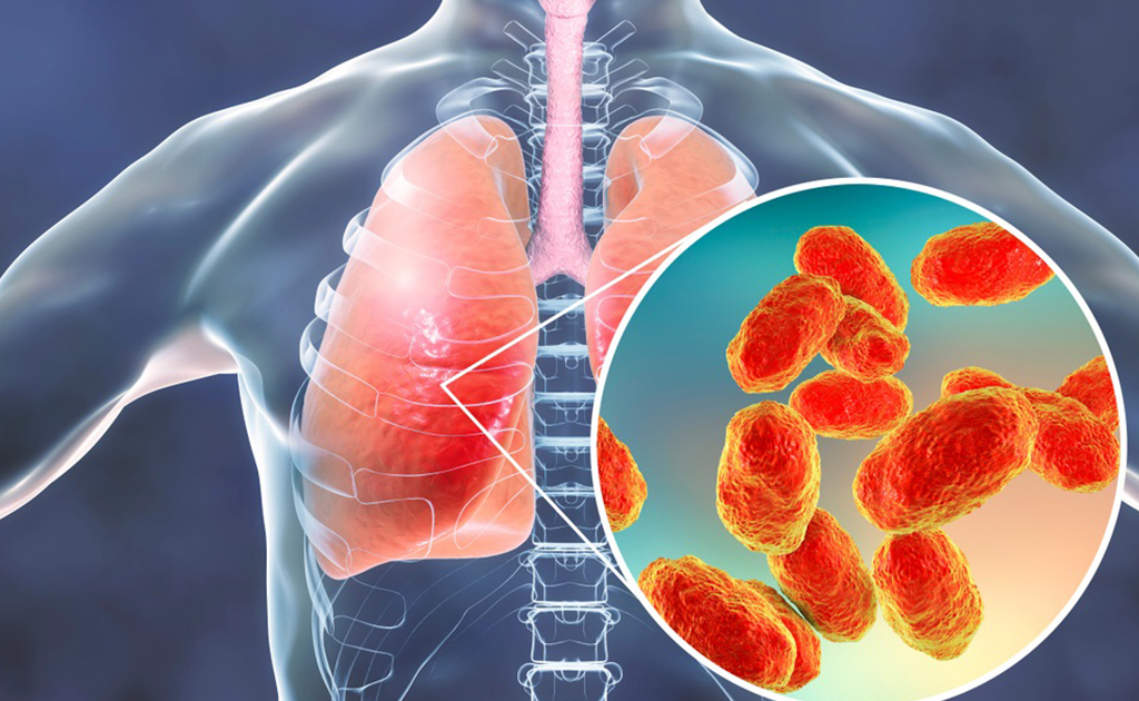 শিশুদের নিউমোনিয়া হলে কোন লক্ষণগুলো দেখে বুঝবেন?