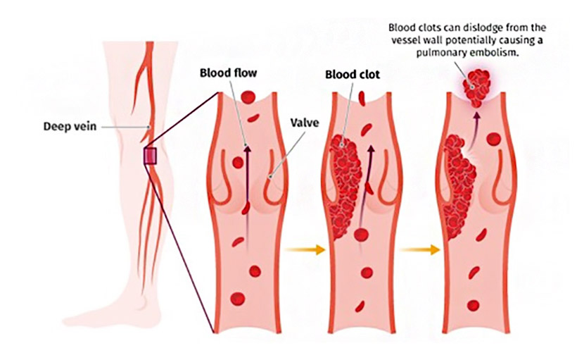 ইমার্জেন্সি কন্ট্রাসেপ্টিভ পিল জন্ম নিয়ন্ত্রণে কিভাবে প্রভাব ফেলে?