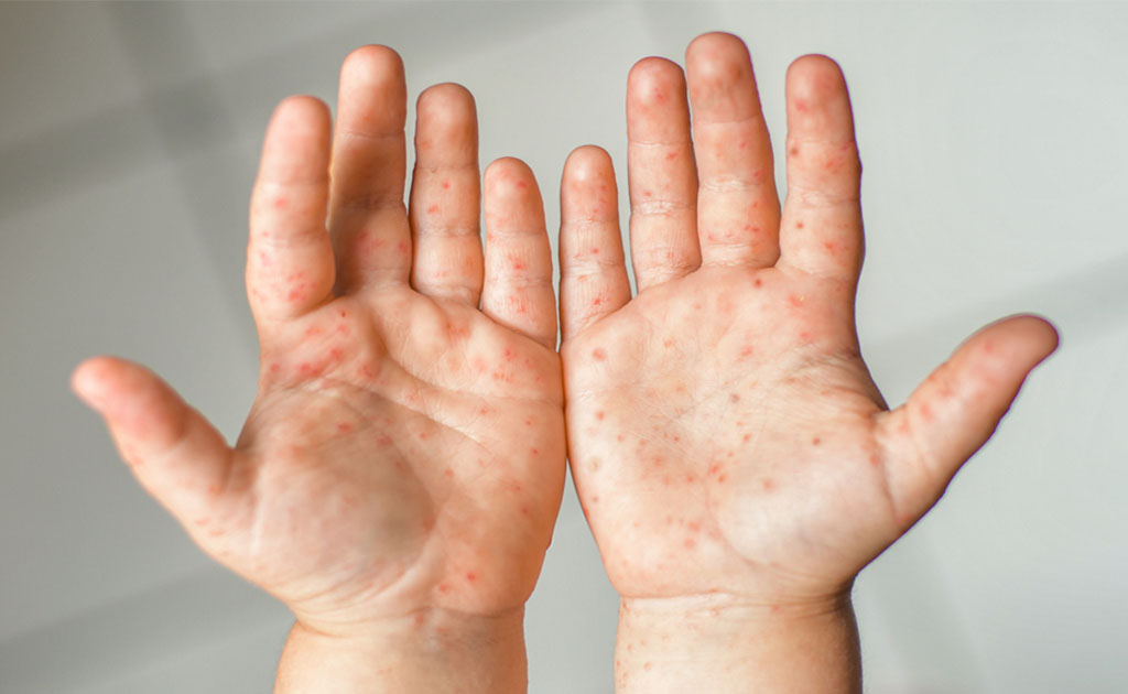 শিশুর হ্যান্ড, ফুট অ্যান্ড মাউথ ডিজিজ প্রতিরোধে যা যা করা প্রয়োজন