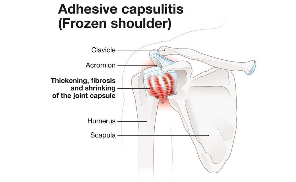 কাঁধ নাড়াতে অসহ্য ব্যথা! ফ্রোজেন শোল্ডার রোগে ভুগছেন না তো?
