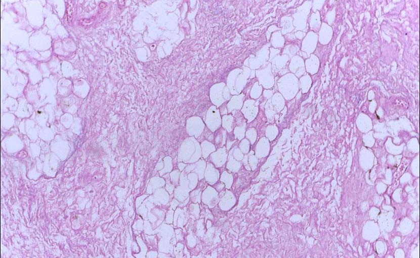 মেয়েদের স্তনে চাকা হওয়ার ৭টি কারণ ও ডাক্তারি পরামর্শ জানেন কি?