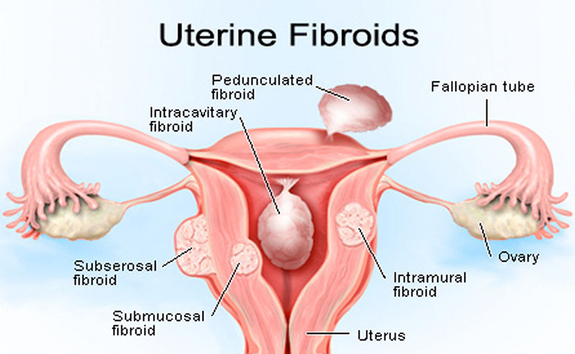 বন্ধ্যাত্বের চিকিৎসা ল্যাপারোস্কপি কখন এবং কেন করা হয়?